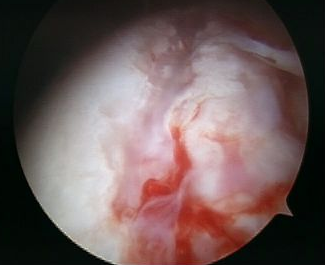 Arthroscopy Hill Sachs Lesion